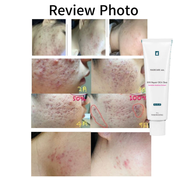 Tosowoong SOS Repair Cica Clinic 50g Acne